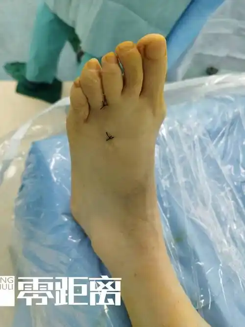 女子脚趾长肿瘤竟是穿鞋不当引发医生这种疾病好发于女性