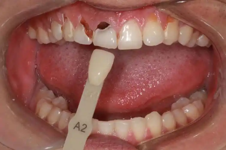 青少年"可乐牙"的治疗