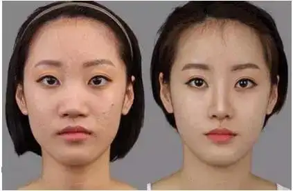 玻尿酸注射前后对比