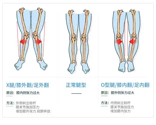 成人儿童宝宝腿型矫正带o型腿x型矫正支架腿部罗圈腿