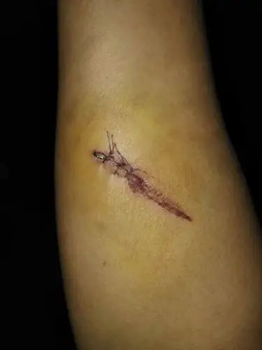 工作时工作中手臂被切割机切伤,去医院缝三针医生说十至十二天拆线