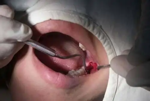 拔智齿后悔死了 不是所有的智齿都能拔哦(哪种不能拔)