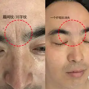 川字纹眉间纹贴去除神器皱纹凹陷填充法令纹鱼尾纹小熨斗日本医朵