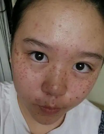 激光祛斑后反黑图片6