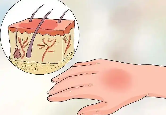 医学科普烧伤患者的皮肤护理