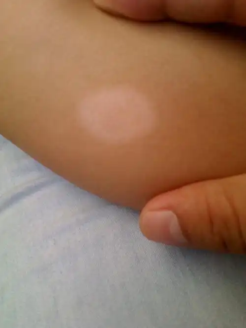 孩子小腿上长了一块白斑两个多月了没变大,中间部分现在略褪色,请问是