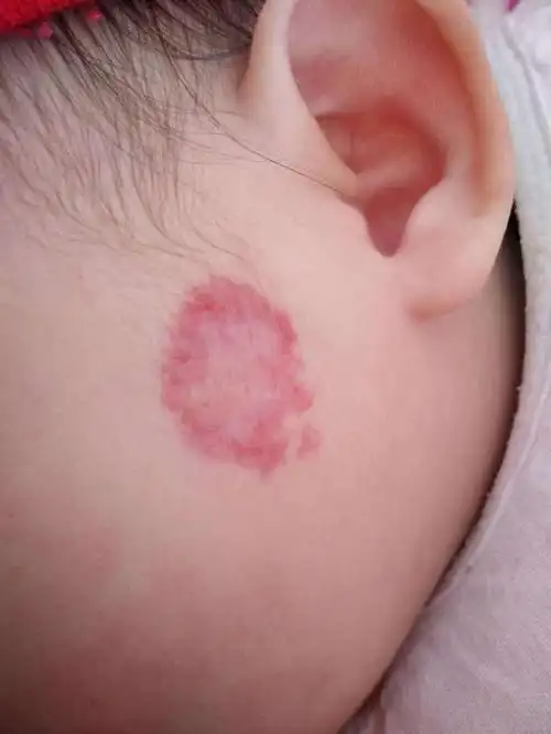 血管瘤图片,治疗血管瘤医院排名,最好的医院,最好治疗方法.