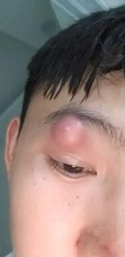 了这么大一个包好几天了也没下去很疼真的很痛这是怎么了眼皮都肿了