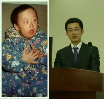 还记得高中生物书上那个21三体综合症的孩子嘛?