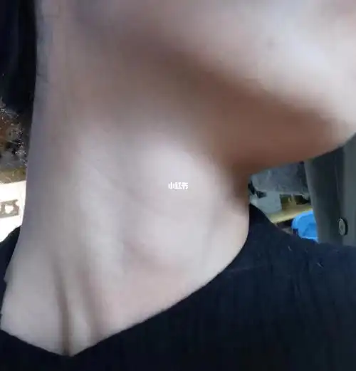 淋巴结肿大有点害怕就去医院做了检查