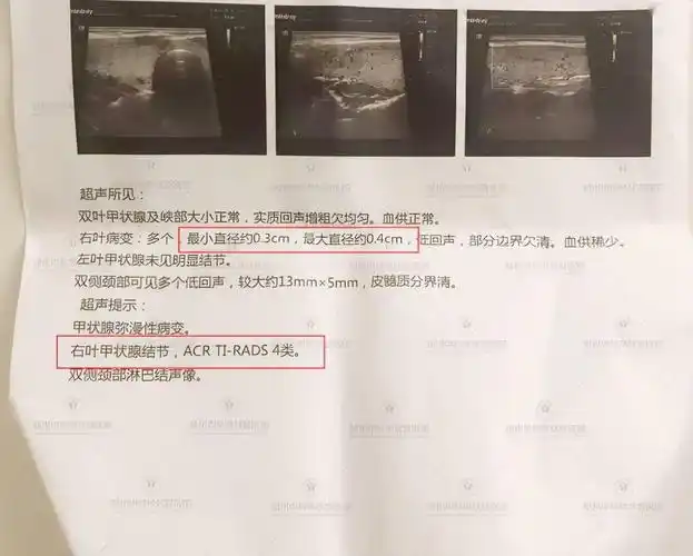 体检发现3毫米结节医生建议观察结果半年竟然成癌