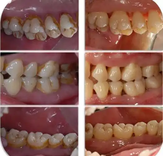 成人慢性牙周炎系统性治疗一例以菌斑控制为导向的牙周治疗2018病例展