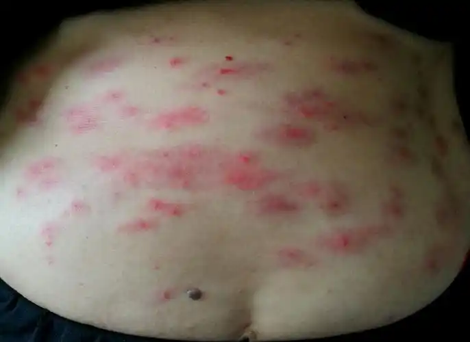 水土不服之"虫咬皮炎"