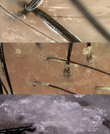 春季敏感高发头皮如何抗敏通关