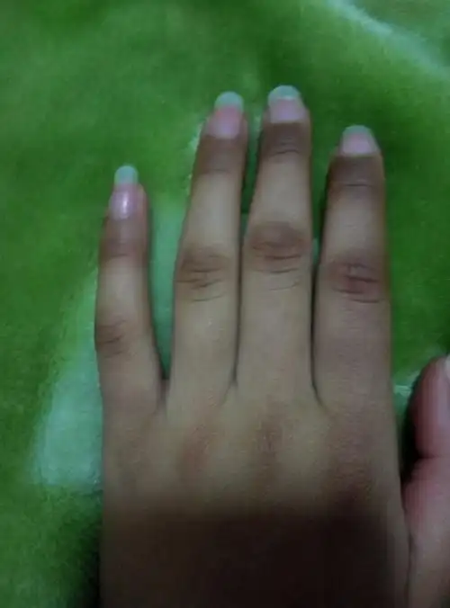 手靠近指甲的位置发黑