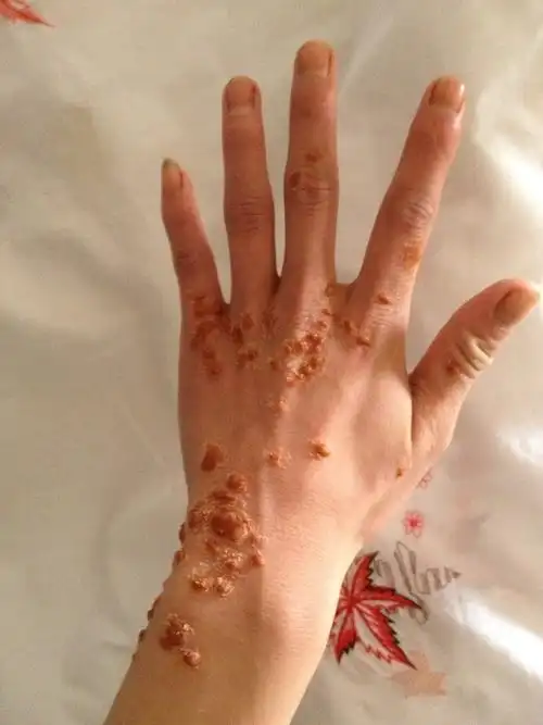 常年在学理发.然后手部如图所示,出现很多这样的疣体,激光了又复发.