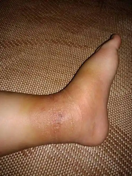 宝宝虫子咬了一下,结果两天之后变成这样的,有谁知道怎么处理吗?