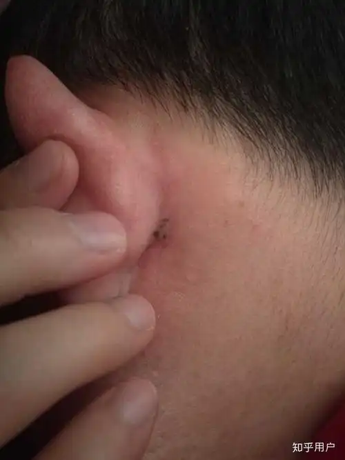 黑头大到直接挤出来是什么感受?