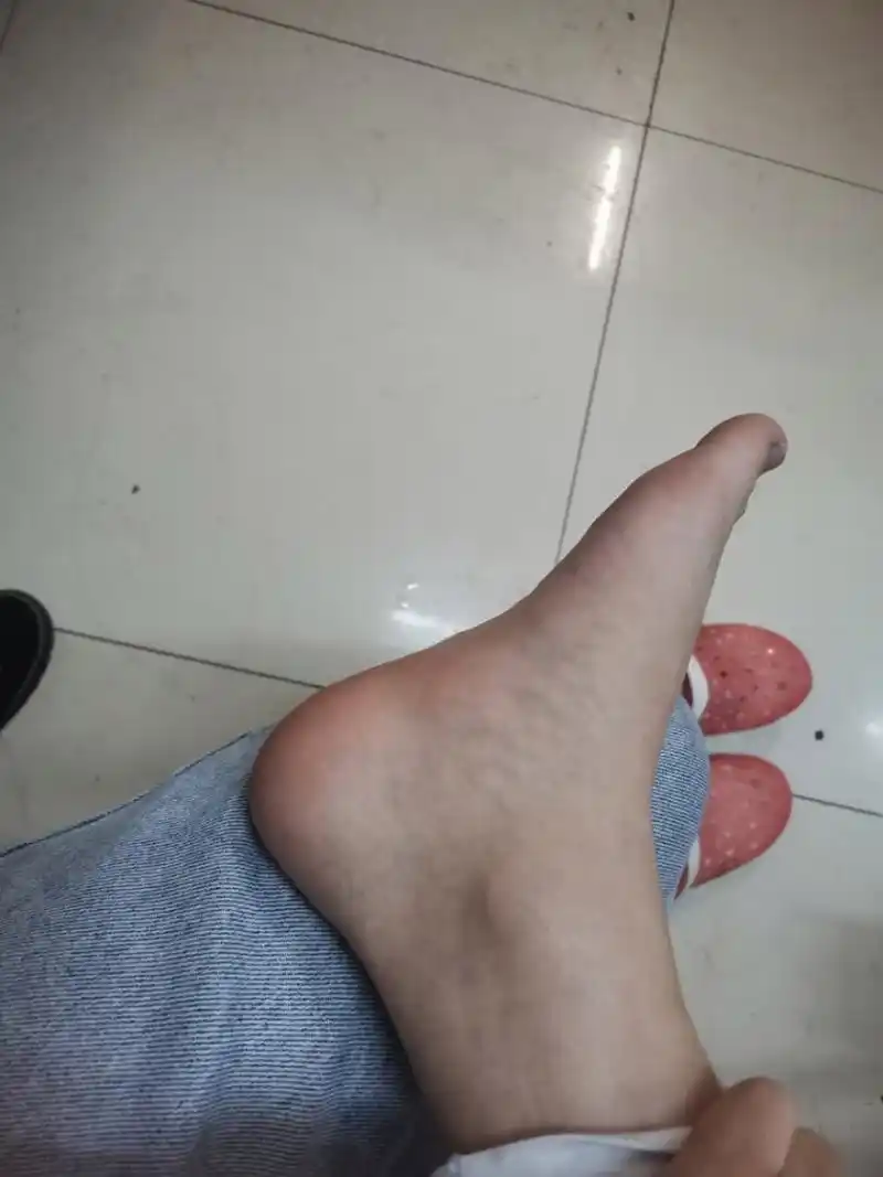 脚足弓内侧肿起 这是怎么了,好久了,姐妹可以帮我看看怎么能消下去?