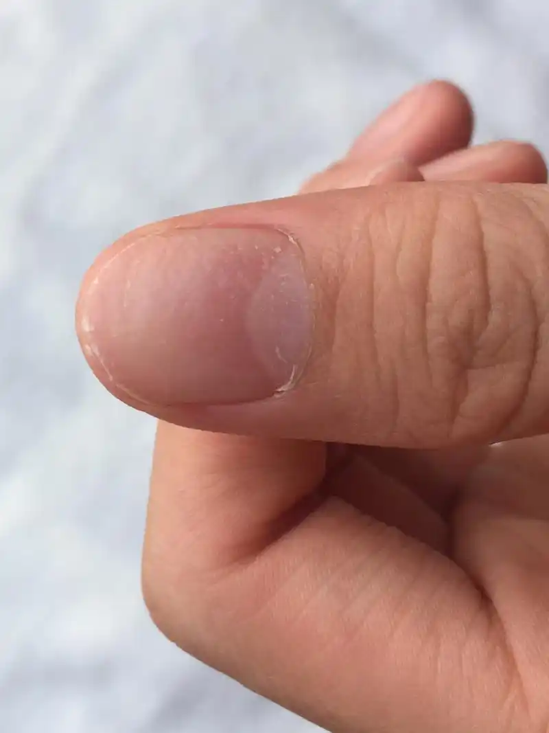 儿子的指甲凹凸不平已经好几年了,老外医生说没得治,只能等它自己好