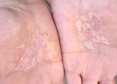 如果是想我这个图片的是手癣,涂药膏效果不好,因为药膏很难通过手部