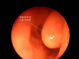 打喷嚏,鼻痒,鼻出血…过敏性鼻炎典型症状