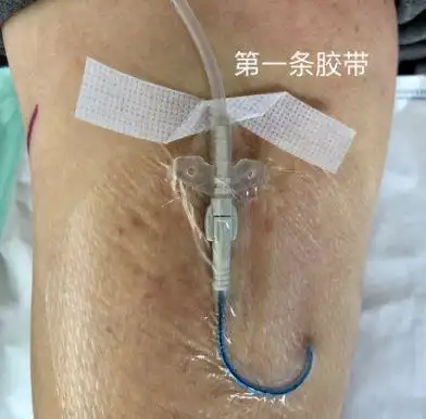 笔者习惯于第一条胶带采用蝶形交叉固定的方法.