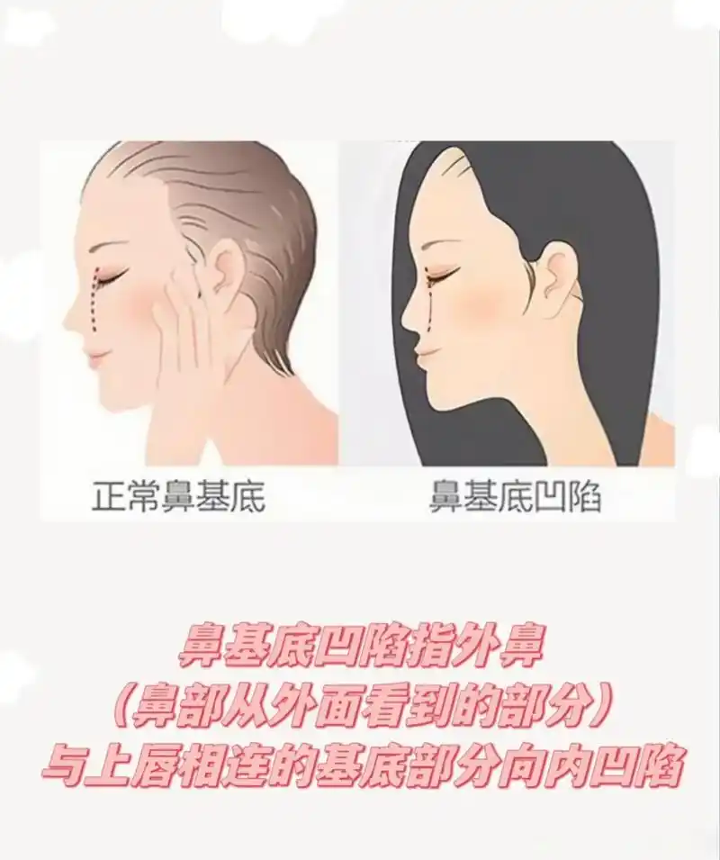 鼻基底凹陷自测93 ◎水平拍一张侧脸照,在山根处画一条垂线,看鼻下