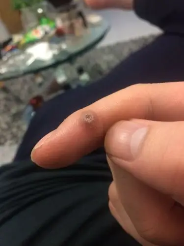 我的手上长了个这个东西,2个月前长的,不疼不痒,这是什么?是瘊子吗?