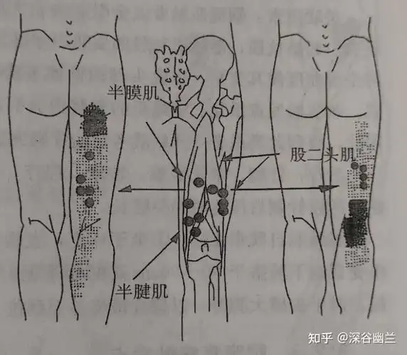 读书笔记腘绳肌触发点