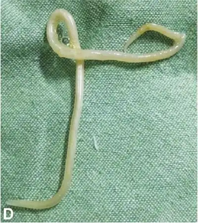 小儿寄生虫病医院_治疗小儿寄生虫病哪家医院好_治疗小儿寄生虫病权威