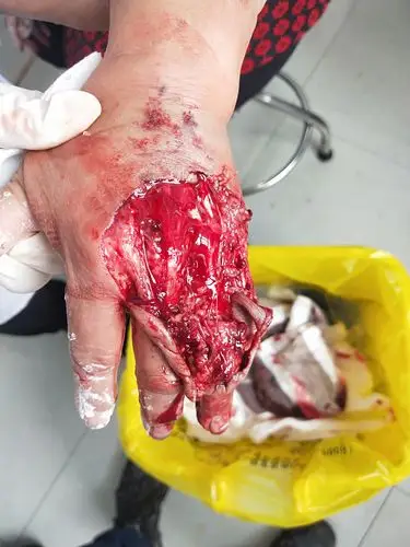 手外创伤伤类病人