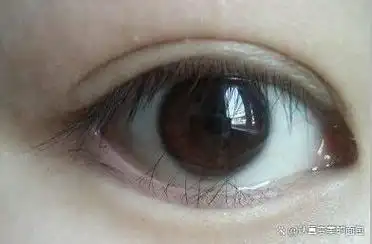 眼角睫毛倒长扎眼睛怎么办?