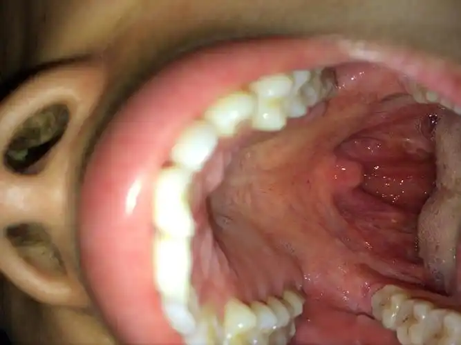 扁桃体上面有类似水泡的东西还发炎了打了青霉素好些了后来有