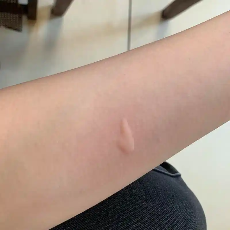 好惨一女的 七夕礼物就是被蚊子咬了三个大包(来比.