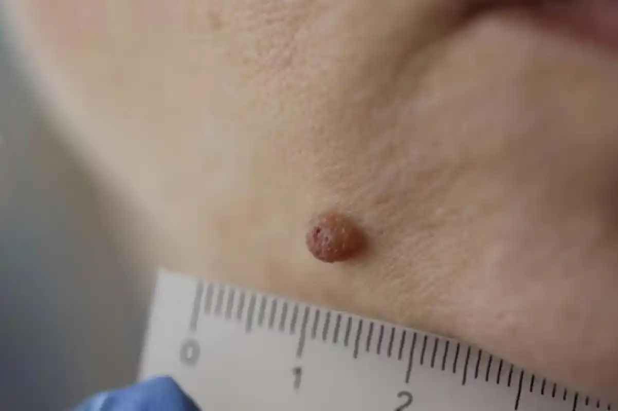 尖锐湿疣,由hpv6及11型病毒感染引起,外观为红色,白色或雾灰色状赘