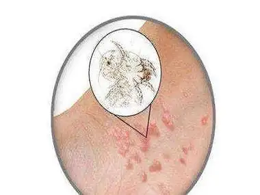 疥疮有哪些危害?_金华婺城皮肤病防治院【官网】