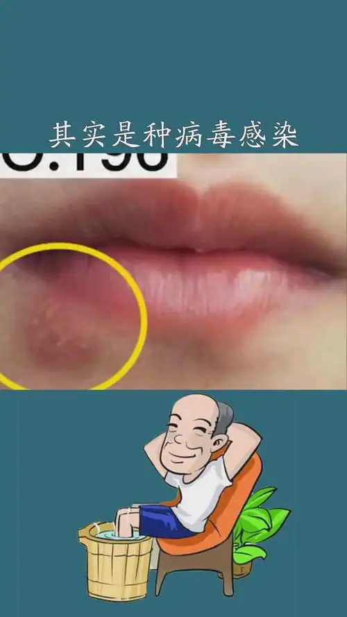 很多人以为是上火,这其实是种病毒感染#单纯疱疹 #健康 #科普 #知识