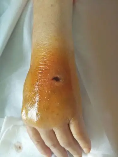 药物外渗皮肤变化及处理.(副本)