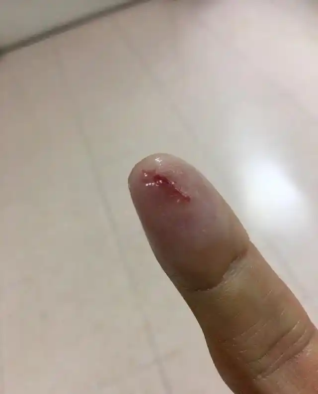 任贤齐手指残留玻璃渣,x光 核磁共振后开刀取出