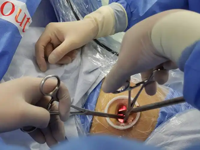 微创胸腔镜肺结节手术简介早期肺癌磨玻璃结节肺结节手术过程介绍