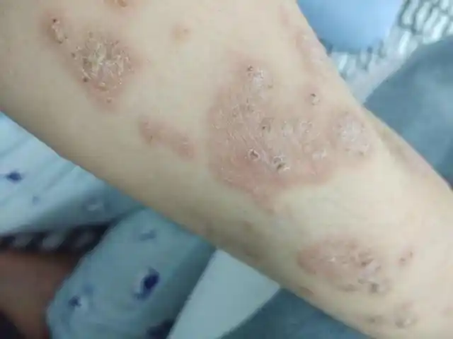 脸上起白癣的图片