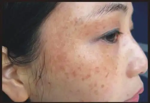 女人这3个阶段最容易长斑一杯温水加上它让斑点去无踪