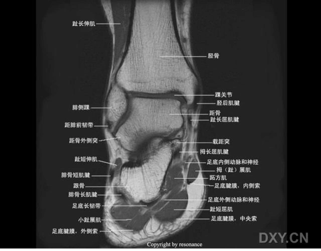 距后三角副骨腓骨下骨儿童骨骺未闭踝关节侧位踝关节正位x线肌骨超声
