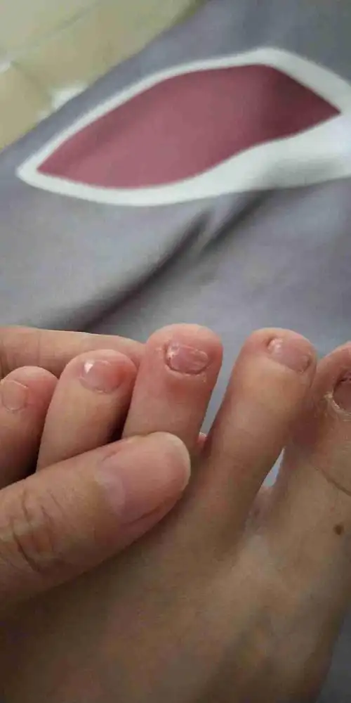 脚趾甲长白斑是怎么回事?