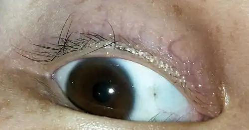 这是左右眼,睫毛经常扎眼睛,眉毛也像睫毛东倒西歪,掉得厉害.