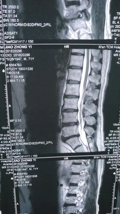 腰椎mr影像