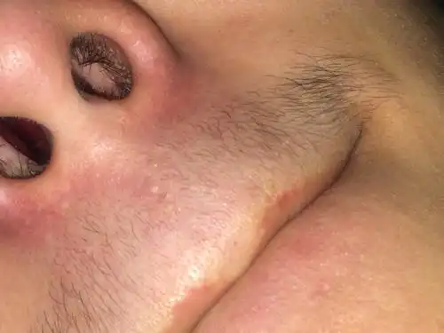 鼻子里面为什么这么红,还感觉肿,缝隙好小一直这样,我腺样体肥大