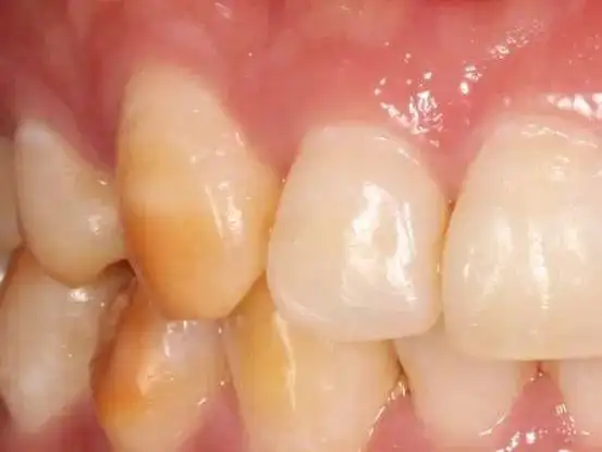 牙齿上的黑斑是怎么回事?