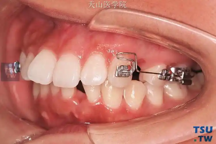 正畸靴形曲弓丝弯制